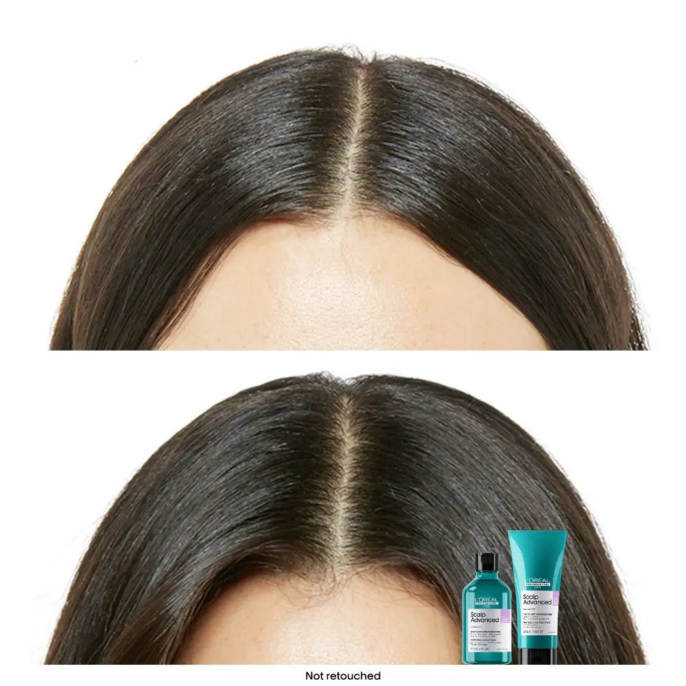 Set L’Oreal Professionnel Serie Expert Scalp Advanced Șampon Dermo-Regulator 300ml + Tratament Calmant pentru Scalp